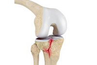 Knee Fracture