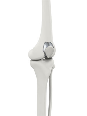 Patello-femoral Knee Replacement