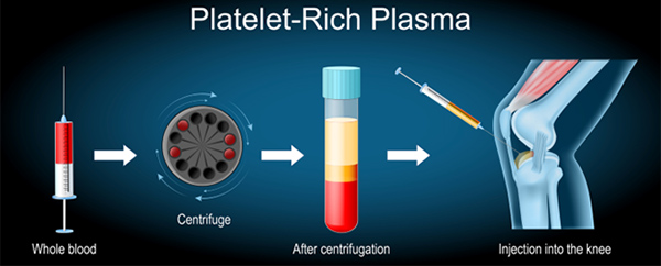 PRP vs. Cortisone: Which Is Better for Joint Pain and Inflammation?